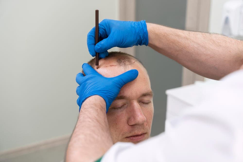 Hair transplant Istanbul for Women with Hair Thinning Issues